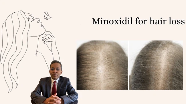 Minoxidil For hair loss Minoxidil For hair loss